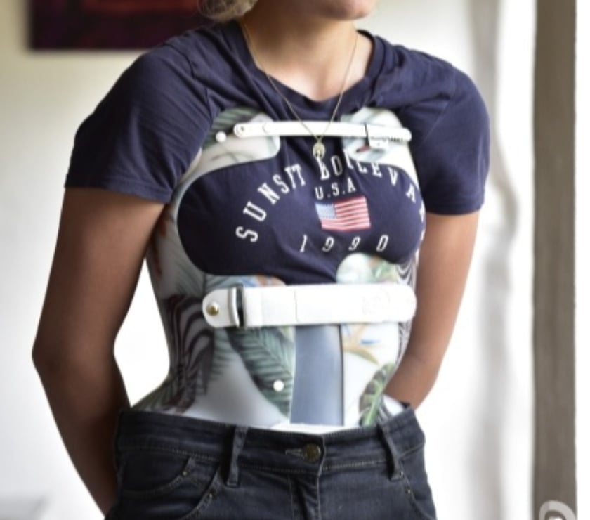 Recherche désespérément une fille avec Corset scoliose..