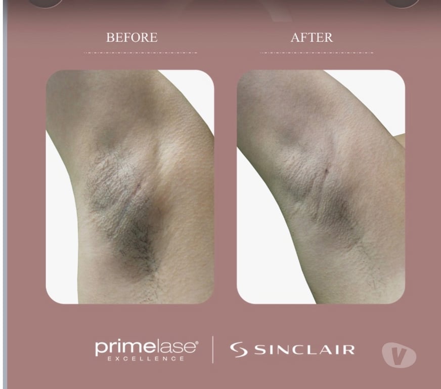 Health-Beauty West Midlands Birmingham - Photos for Laser Hair Removal