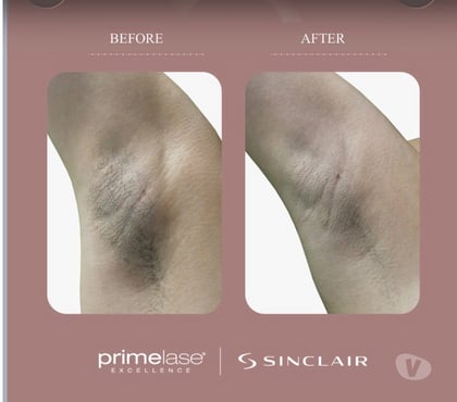 Health-Beauty Kingstanding Birmingham - Photos for Laser Hair Removal
