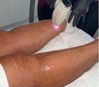 Burton - East Staffordshire — Facials & Laser Hair Removal Clinic Burton on Trent