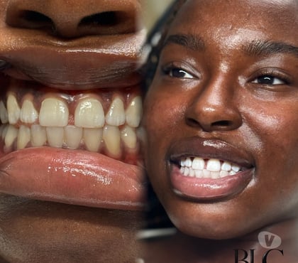 Photos for TEETH WHITENING + TOOTH GEMS | BIRMINGHAM | APPOINTMENTS